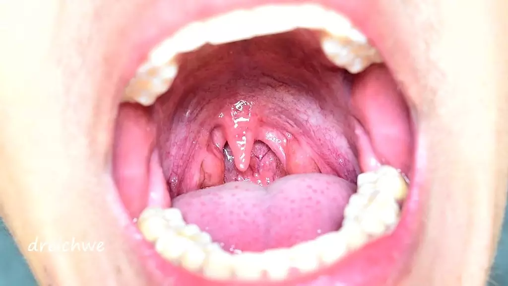 uvula in the foreground - collection 12