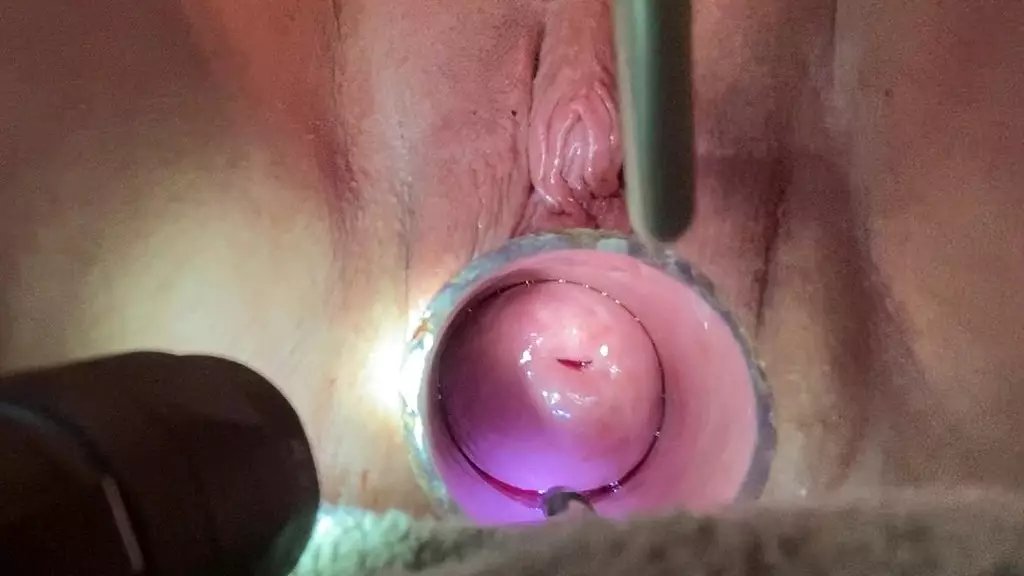 frozen sound penetrates cervix with tenaculum